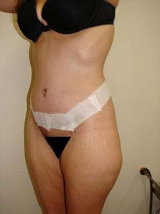 Tummy Tuck Before & After Patient #837