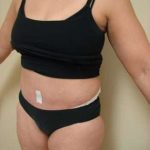 Tummy Tuck Before & After Patient #840
