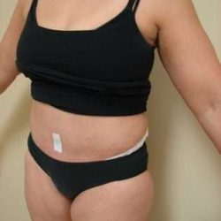 Tummy Tuck Before & After Patient #840