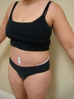 Tummy Tuck Before & After Patient #840