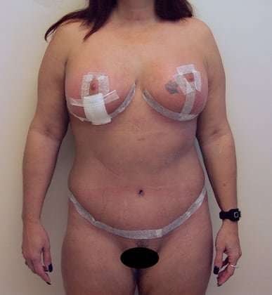 Tummy Tuck Before & After Patient #843