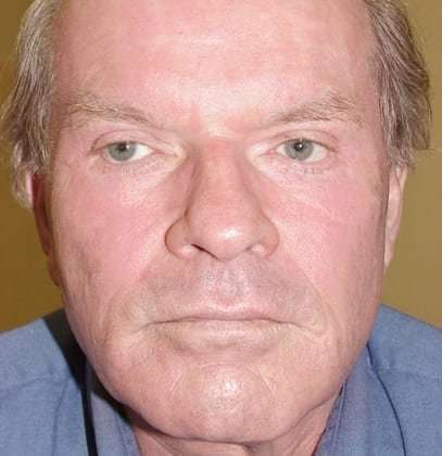 Laser Resurfacing Before & After Patient #128