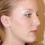 Rhinoplasty Before & After Patient #188