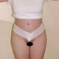 Tummy Tuck Before & After Patient #846