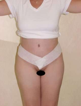 Tummy Tuck Before & After Patient #846