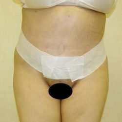 Tummy Tuck Before & After Patient #849