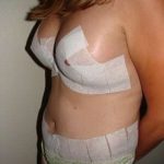 Tummy Tuck Before & After Patient #858