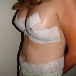 Tummy Tuck Before & After Patient #858