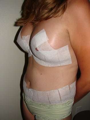 Tummy Tuck Before & After Patient #858