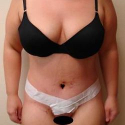 Tummy Tuck Before & After Patient #869