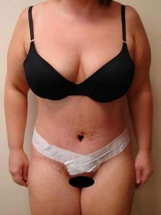 Tummy Tuck Before & After Patient #869