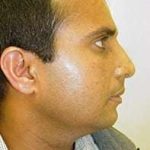 Rhinoplasty Before & After Patient #191