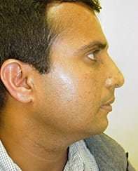 Rhinoplasty Before & After Patient #191