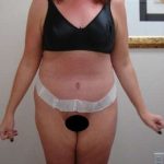 Tummy Tuck Before & After Patient #882