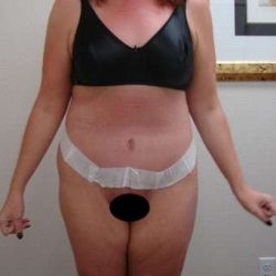 Tummy Tuck Before & After Patient #882