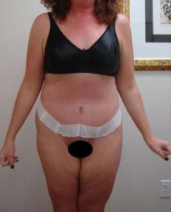 Tummy Tuck Before & After Patient #882