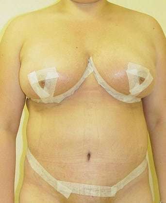 Tummy Tuck Before & After Patient #891