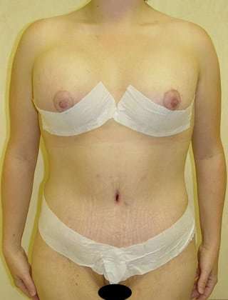 Tummy Tuck Before & After Patient #899
