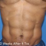 truSculpt® Before & After Patient #915