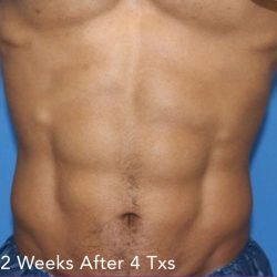 truSculpt® Before & After Patient #915