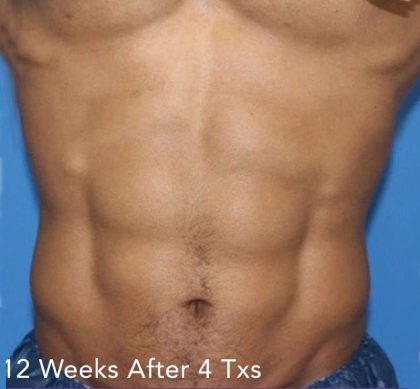 truSculpt&reg; Before & After Patient #915