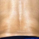 truSculpt® Before & After Patient #919