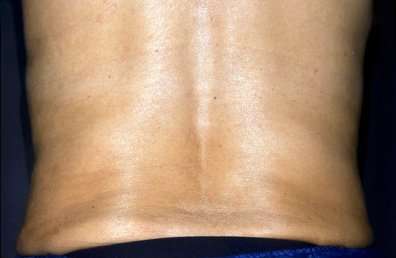 truSculpt&reg; Before & After Patient #919