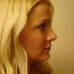 Rhinoplasty Before & After Patient #194