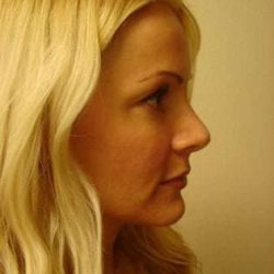 Rhinoplasty Before & After Patient #194