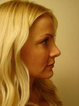 Rhinoplasty Before & After Patient #194