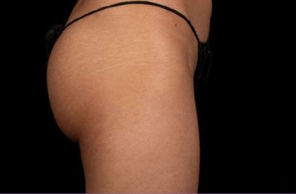 truSculpt&reg; Before & After Patient #922