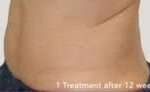 truSculpt® Before & After Patient #925