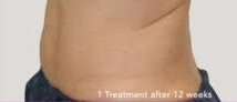 truSculpt® Before & After Patient #925