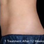 truSculpt® Before & After Patient #930