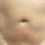 truSculpt® Before & After Patient #933