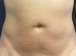truSculpt® Before & After Patient #933