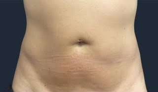truSculpt® Before & After Patient #933