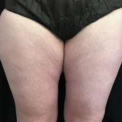 truSculpt® Before & After Patient #936