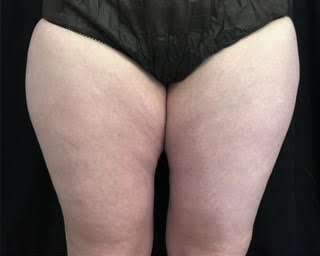 truSculpt® Before & After Patient #936