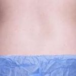 truSculpt® Before & After Patient #943
