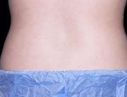 truSculpt® Before & After Patient #943