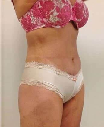 Mommy Makeover Before & After Patient #946