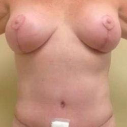 Mommy Makeover Before & After Patient #956