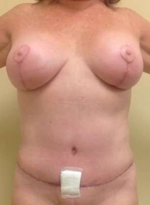 Mommy Makeover Before & After Patient #956