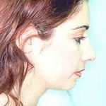 Rhinoplasty Before & After Patient #197