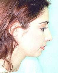Rhinoplasty Before & After Patient #197
