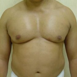Male Chest Implant Before & After Patient #980