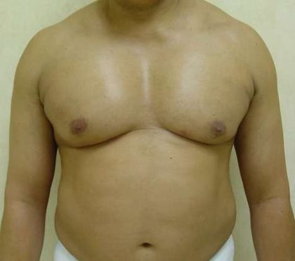 Male Chest Implant Before & After Patient #980