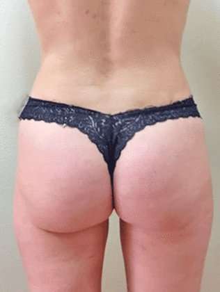 Liposuction Before & After Patient #988