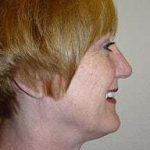 Rhinoplasty Before & After Patient #200
